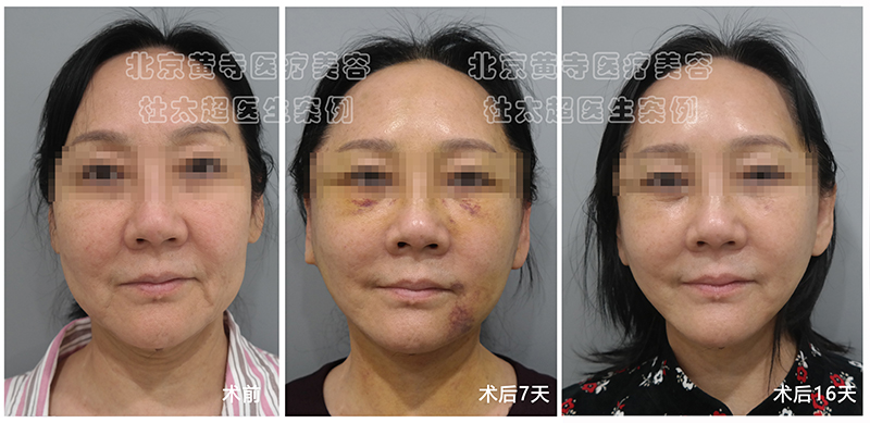 小切口拉皮手术后7天，16天