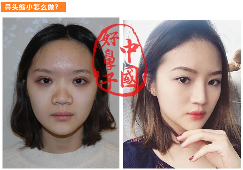 鼻头缩小术整个过程是怎样的呢? 鼻头缩小术整个过程是怎样的呢?