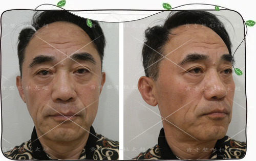 从有想法改变到整形完成一共用了不到48小时