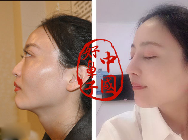 鼻子要求垫多高才算美呢? 鼻子要求垫多高才算美呢?