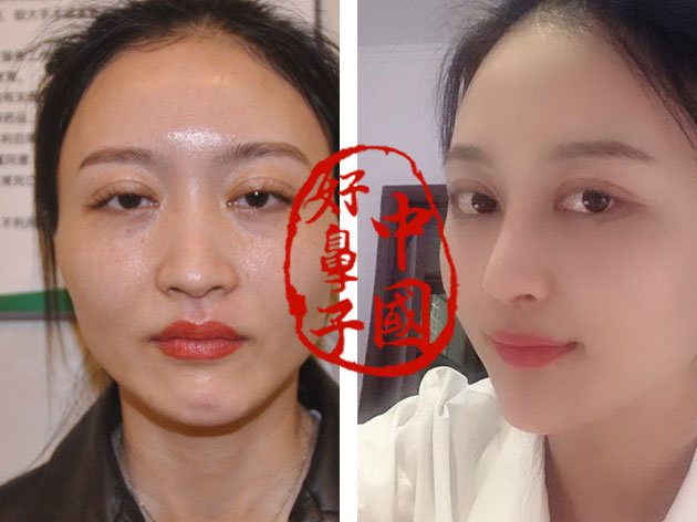 鼻子要求垫多高才算美呢? 鼻子要求垫多高才算美呢?