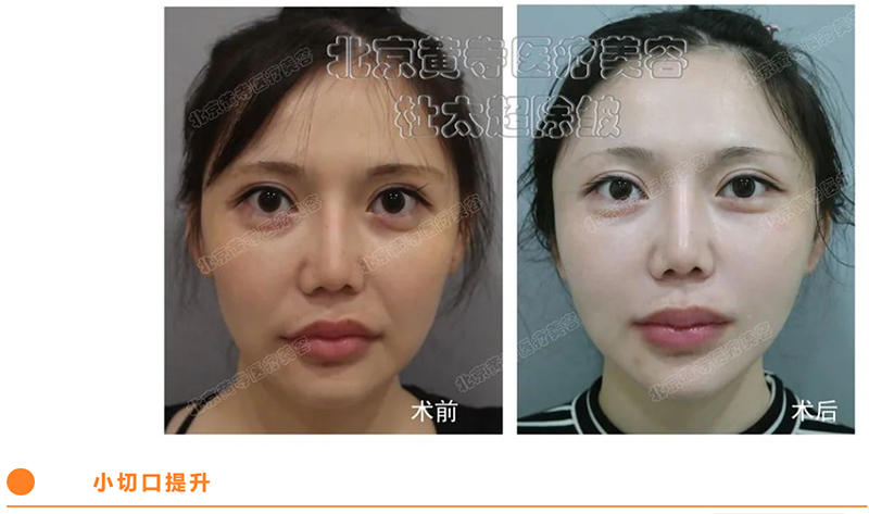 小切口拉皮真的适合30岁左右的人群吗? 小切口拉皮真的适合30岁左右的人群吗?