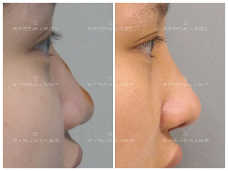 超叔教大家一些隆鼻避坑的小技巧