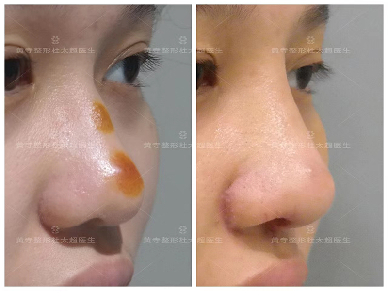 超叔教大家一些隆鼻避坑的小技巧