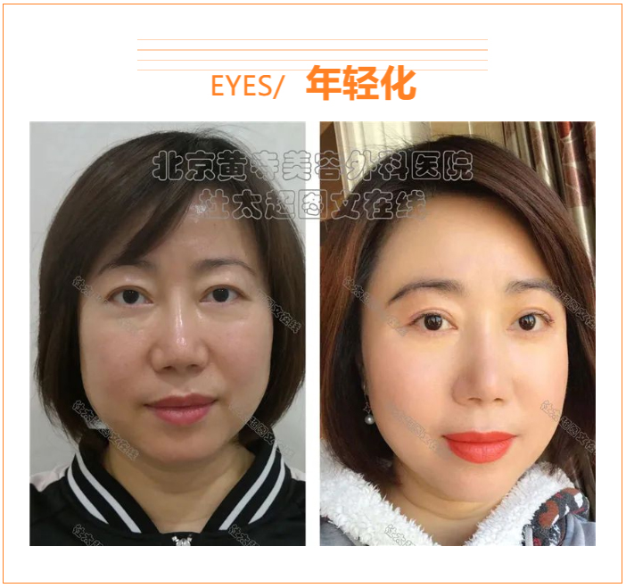 如何防止眼皮松弛? 如何防止眼皮松弛?