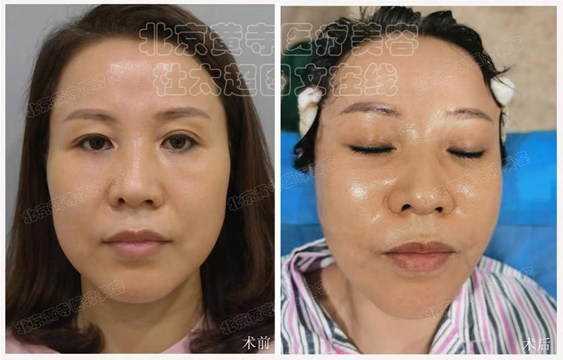 微创术式小切口拉皮 微创术式小切口拉皮