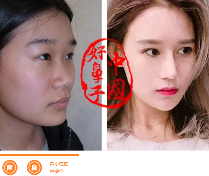 鼻小柱塑形的重要性！