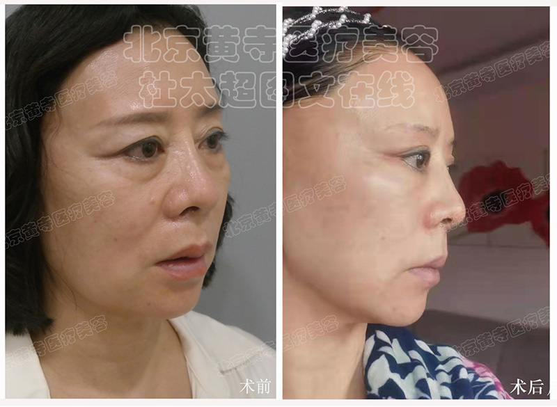 面部年轻化+眼周年轻化最新反馈图片 面部年轻化+眼周年轻化最新反馈图片