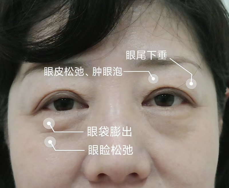 如何判断自己适合的眼周年轻化术式 如何判断自己适合的眼周年轻化术式