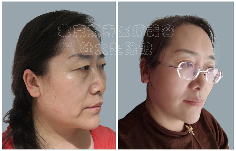 鱼尾纹出现怎么做? 鱼尾纹出现怎么做?