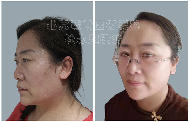 鱼尾纹出现怎么做? 鱼尾纹出现怎么做?