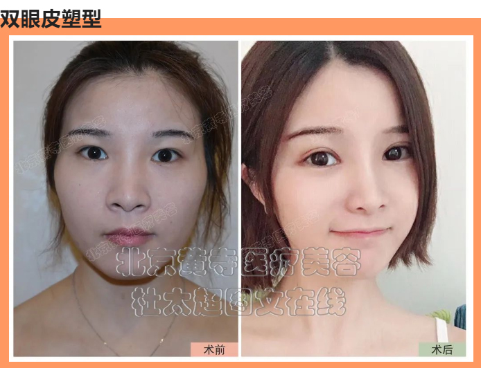 双眼皮塑型能改善哪些部位呢? 双眼皮塑型能改善哪些部位呢?
