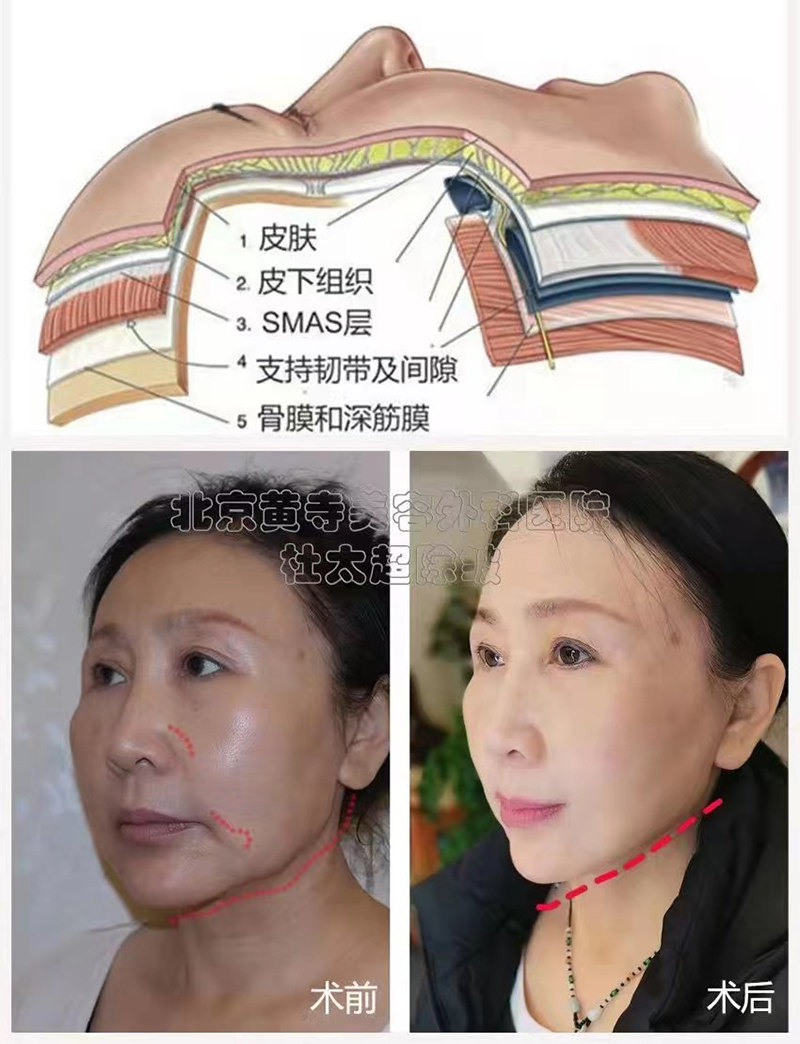 小切口拉皮知识点解析 小切口拉皮知识点解析