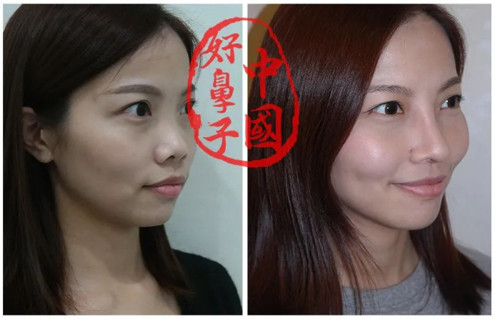 鼻整形——软骨那么多种,我该如何选? 鼻整形——软骨那么多种,我该如何选?