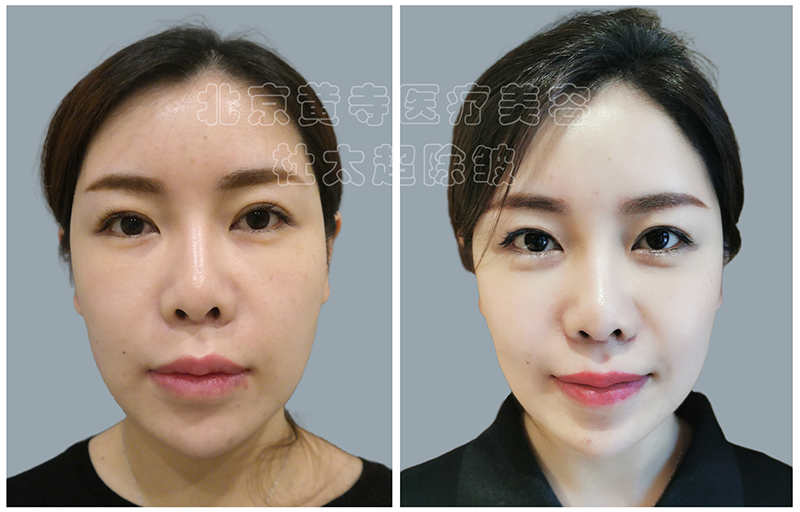 小拉皮手术会不会导致面瘫? 小拉皮手术会不会导致面瘫?