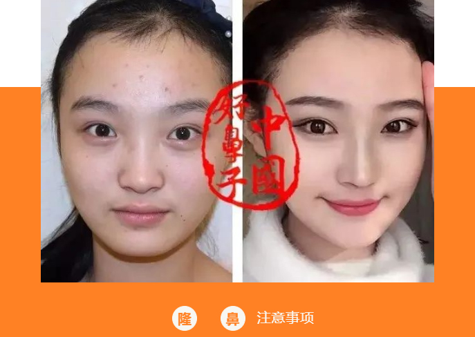 想做鼻子的您是否也有这样的顾虑? 想做鼻子的您是否也有这样的顾虑?