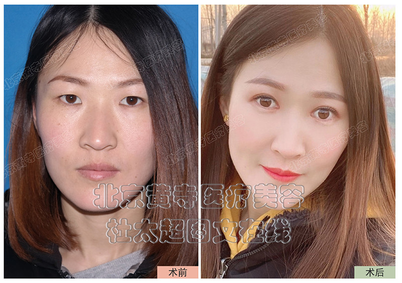 什么样的双眼皮才好看? 什么样的双眼皮才好看?