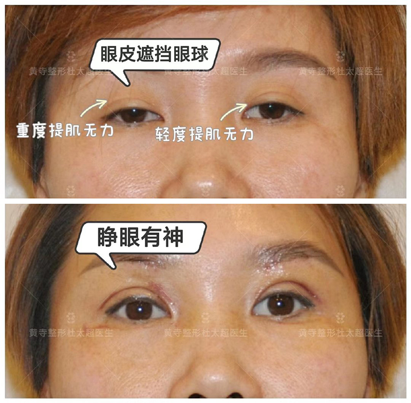 睁眼无力的解决方法 睁眼无力的解决方法