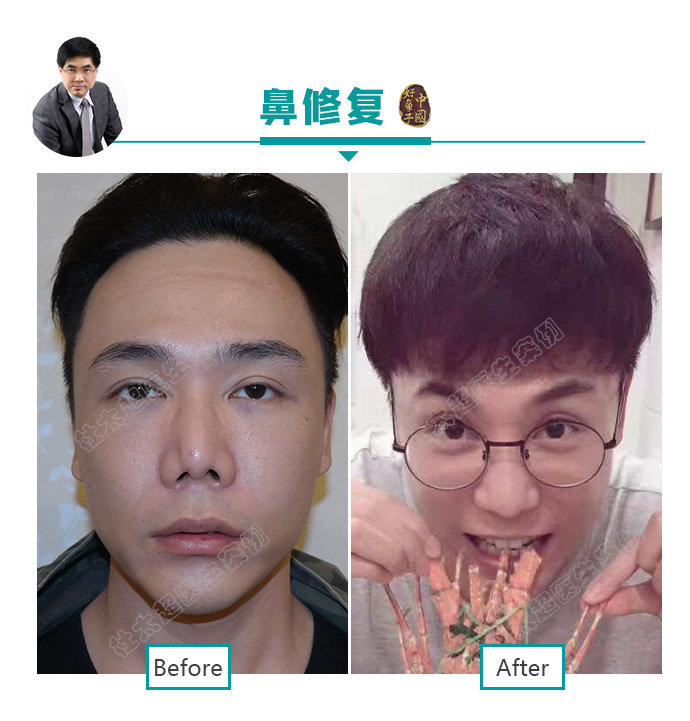 “因鼻制宜” 鼻子整形的全攻略赶紧来了解一下吧 “因鼻制宜” 鼻子整形的全攻略赶紧来了解一下吧