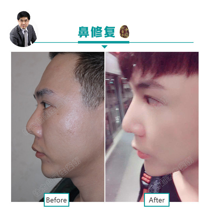 “因鼻制宜” 鼻子整形的全攻略赶紧来了解一下吧 “因鼻制宜” 鼻子整形的全攻略赶紧来了解一下吧