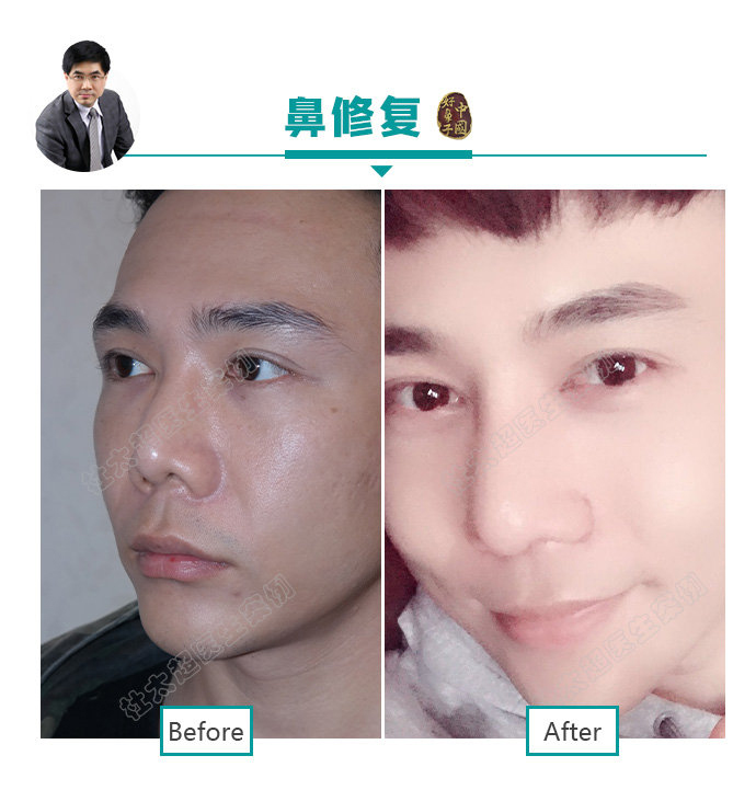 “因鼻制宜” 鼻子整形的全攻略赶紧来了解一下吧 “因鼻制宜” 鼻子整形的全攻略赶紧来了解一下吧