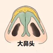 大鼻头缩小如何做? 大鼻头缩小如何做?