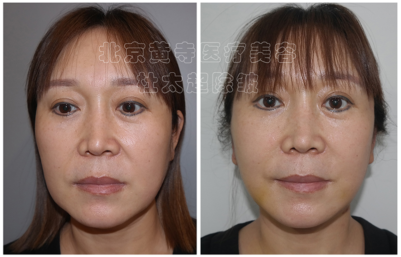 小切口拉皮面部提升,术前VS术后7天 小切口拉皮面部提升,术前VS术后7天