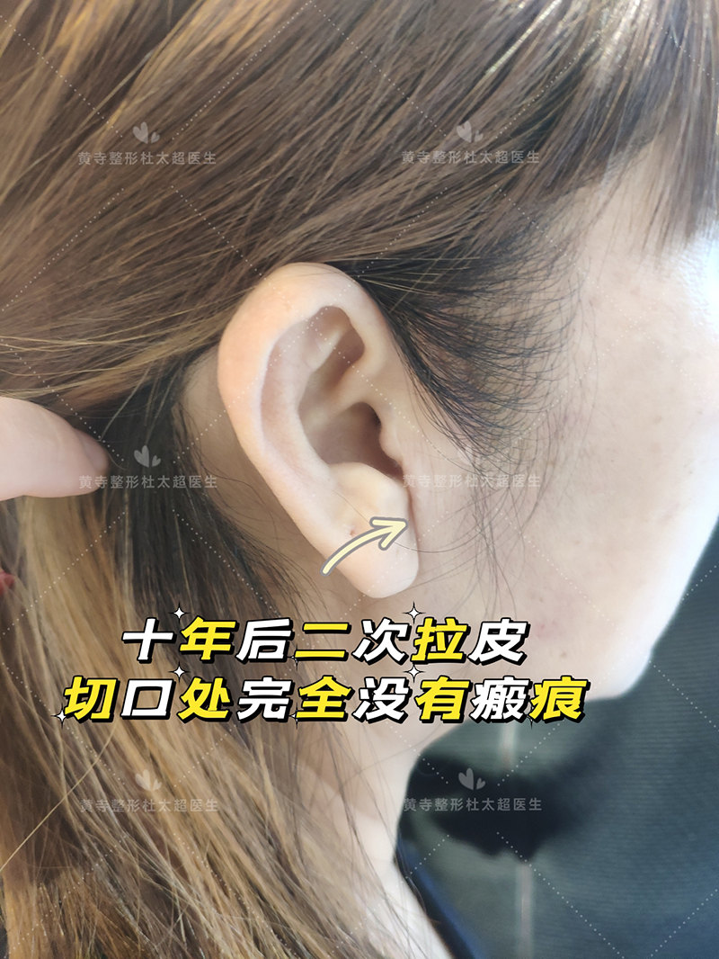 小切口拉皮切口缝合是关键 小切口拉皮切口缝合是关键