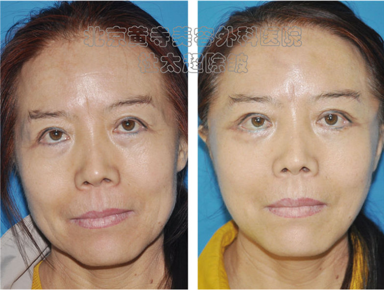 什么是面部除皱术