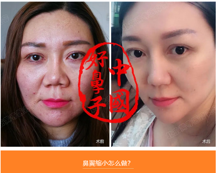 你需要做鼻翼缩小手术吗? 你需要做鼻翼缩小手术吗?