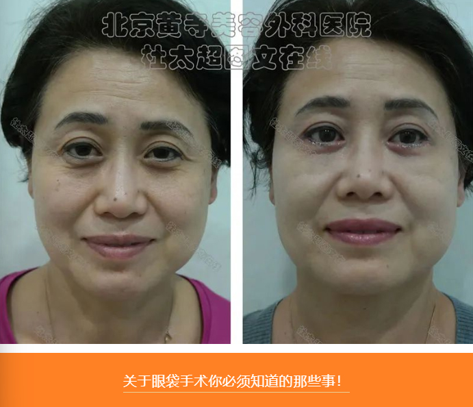 眼袋手术的那些事儿！