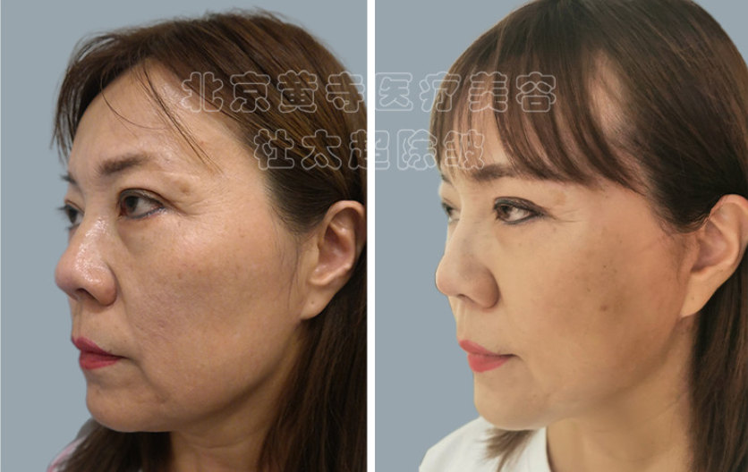 小切口除皱术多久恢复