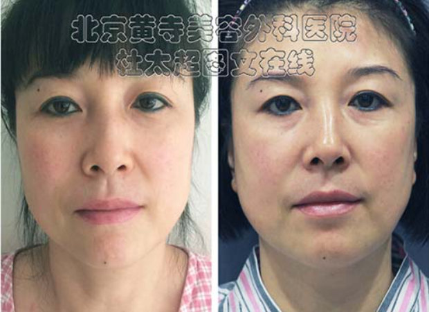 面部提升术后的注意事项