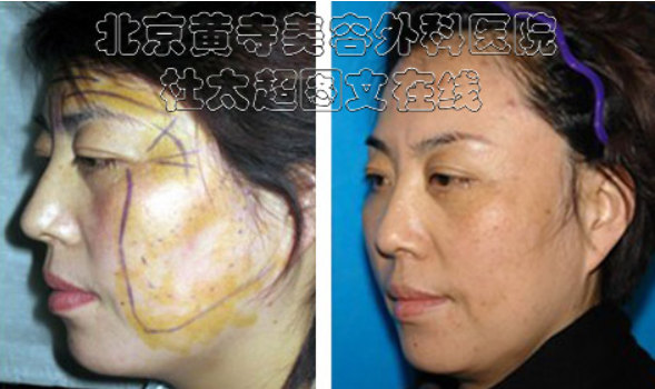 面部提升术效果怎么样？