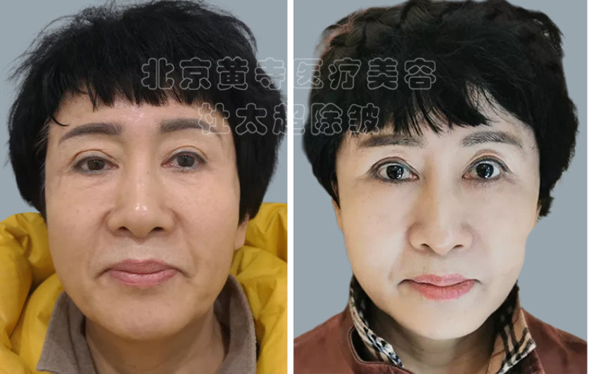 脸上皱纹产生的原因