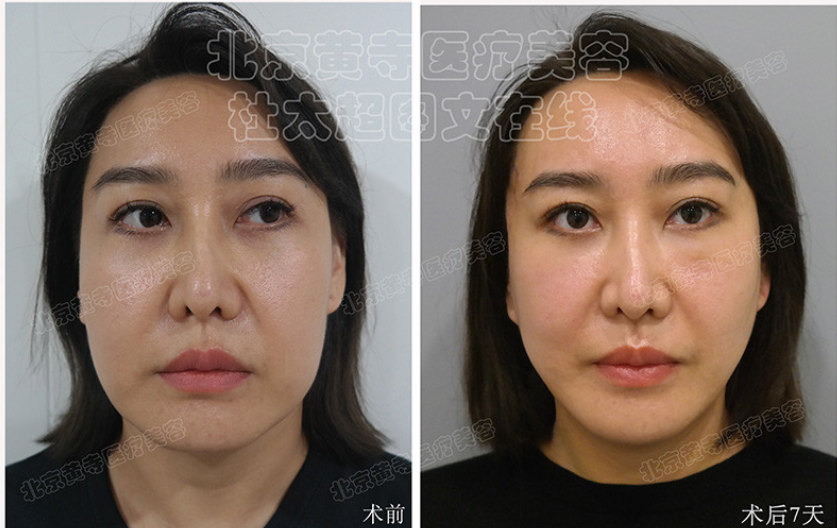 脸上皱纹怎样祛除