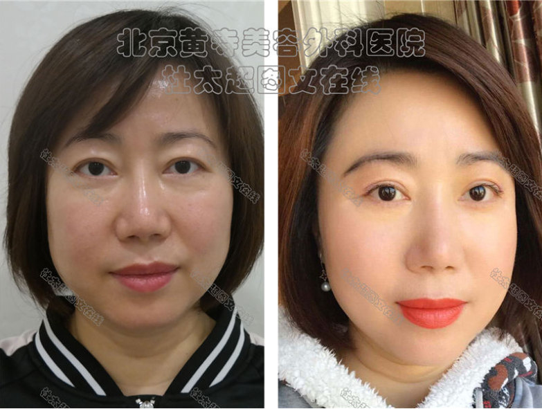 眼皮松弛怎么改善