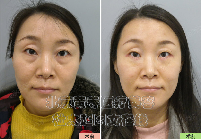 如何按摩去除眼部细纹呢