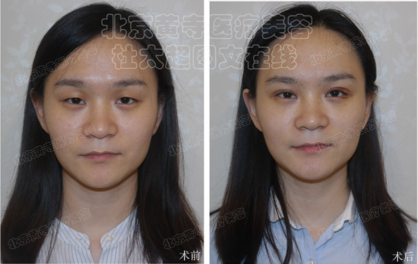 日常眼部护理需注意哪些