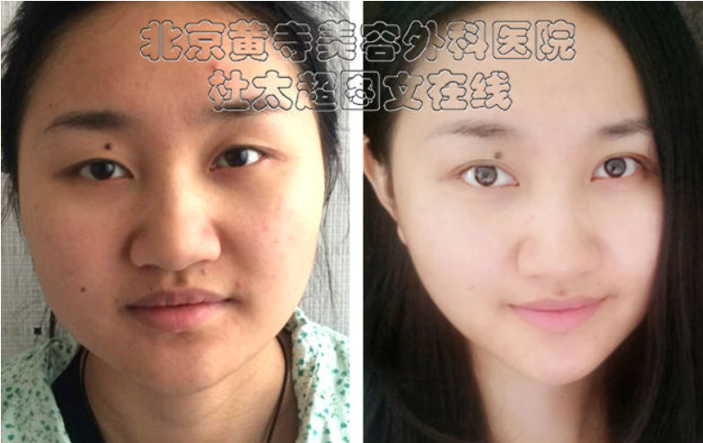 眼角皱纹去除的方法推荐