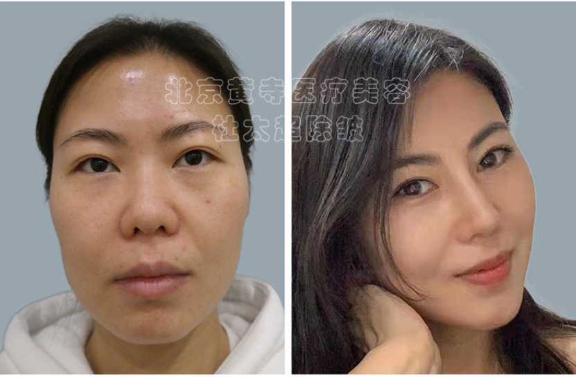 脸上皱纹多是什么原因造成的