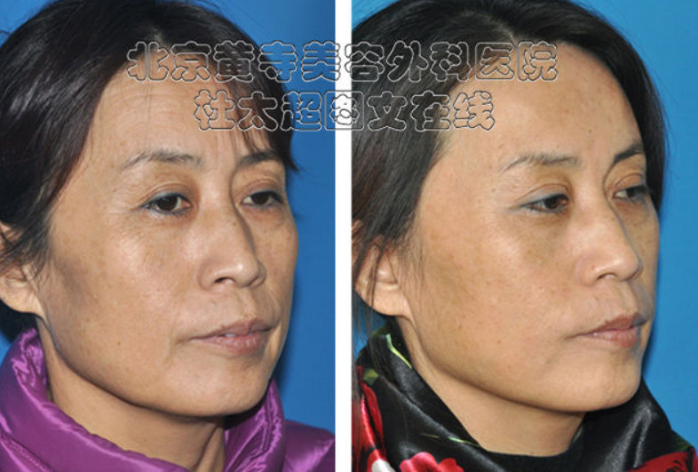 川字纹怎么永久消除