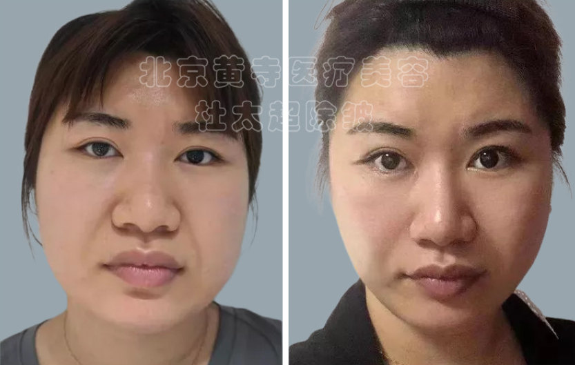 全面部微创除皱术