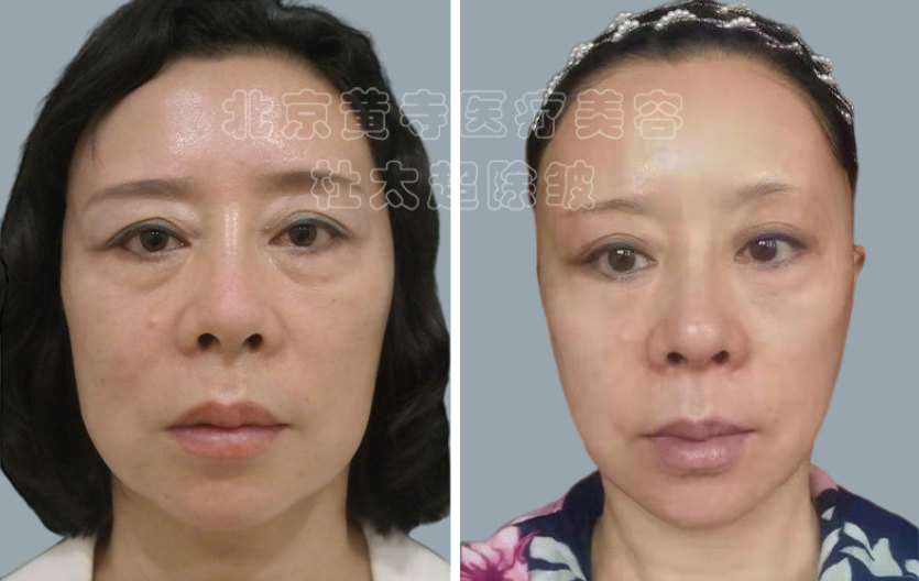 小切口除皱手术的优点