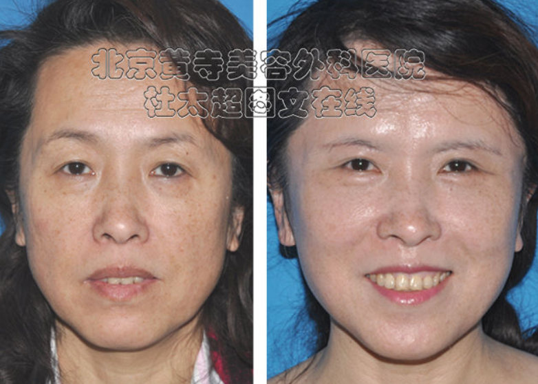 额头小切口如何祛皱的效果最好？