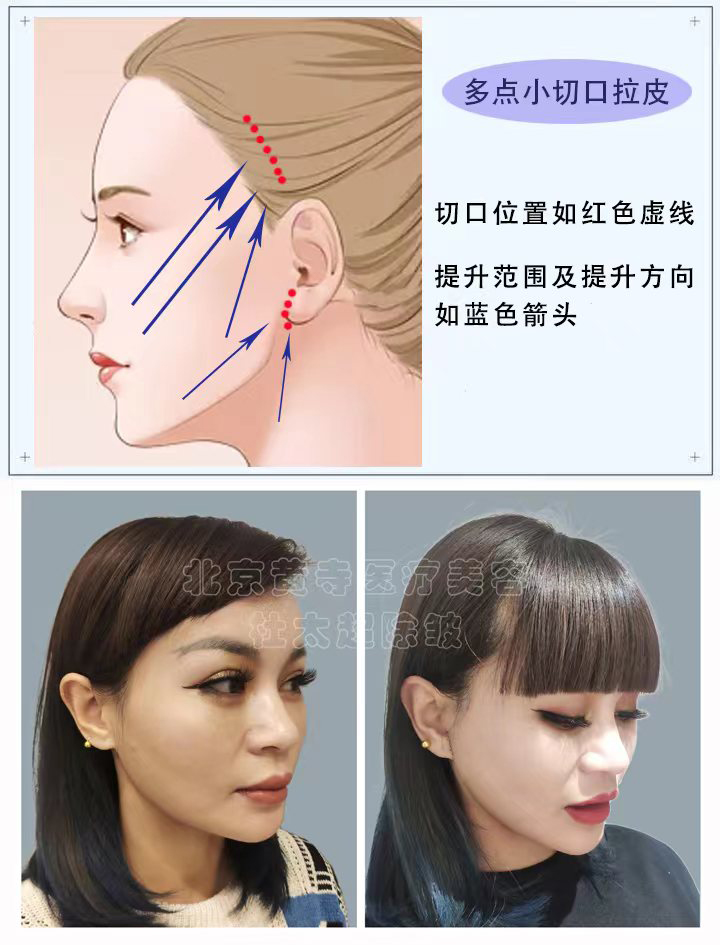 多点小切口拉皮知识点