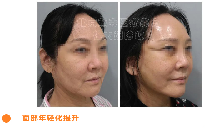 小切口提升的效果到底有多稳定? 小切口提升的效果到底有多稳定?