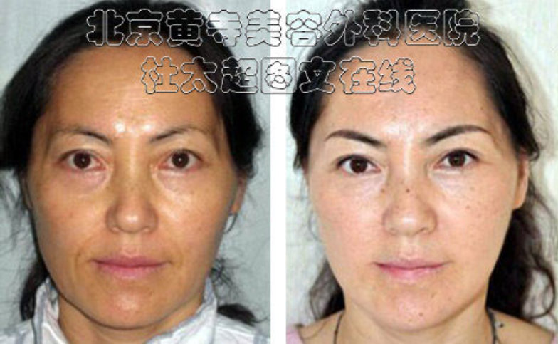 额部提升术的禁忌