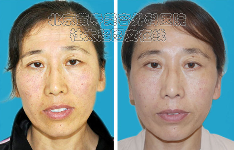 鱼尾纹除皱术注意事项