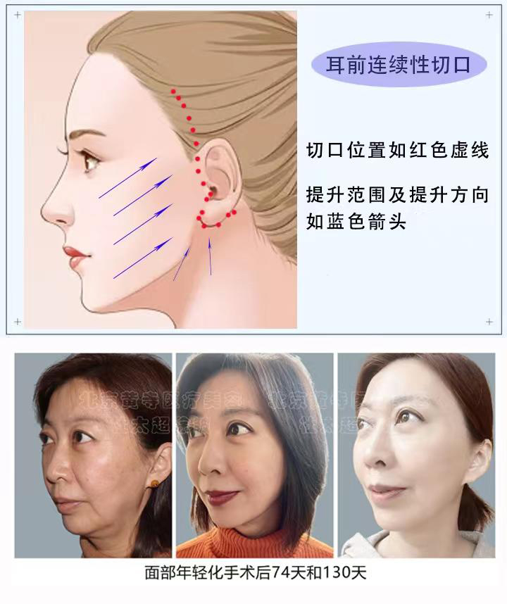 耳前连续性切口知识点